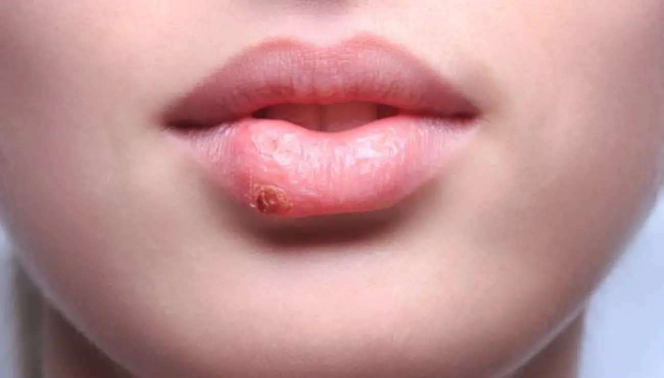 Como curar el herpes labial