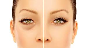 quitar las ojeras y bolsas de los ojos