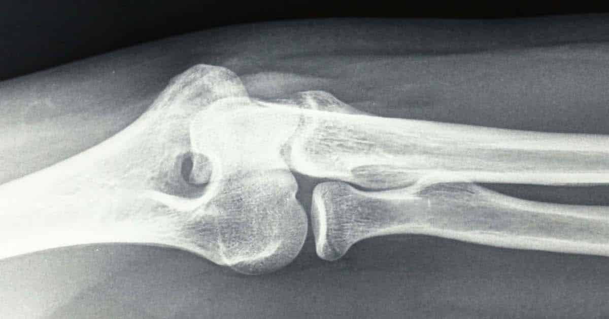 El fabricante de dispositivos de rayos X portátiles OXOS Medical obtiene $ 23 millones